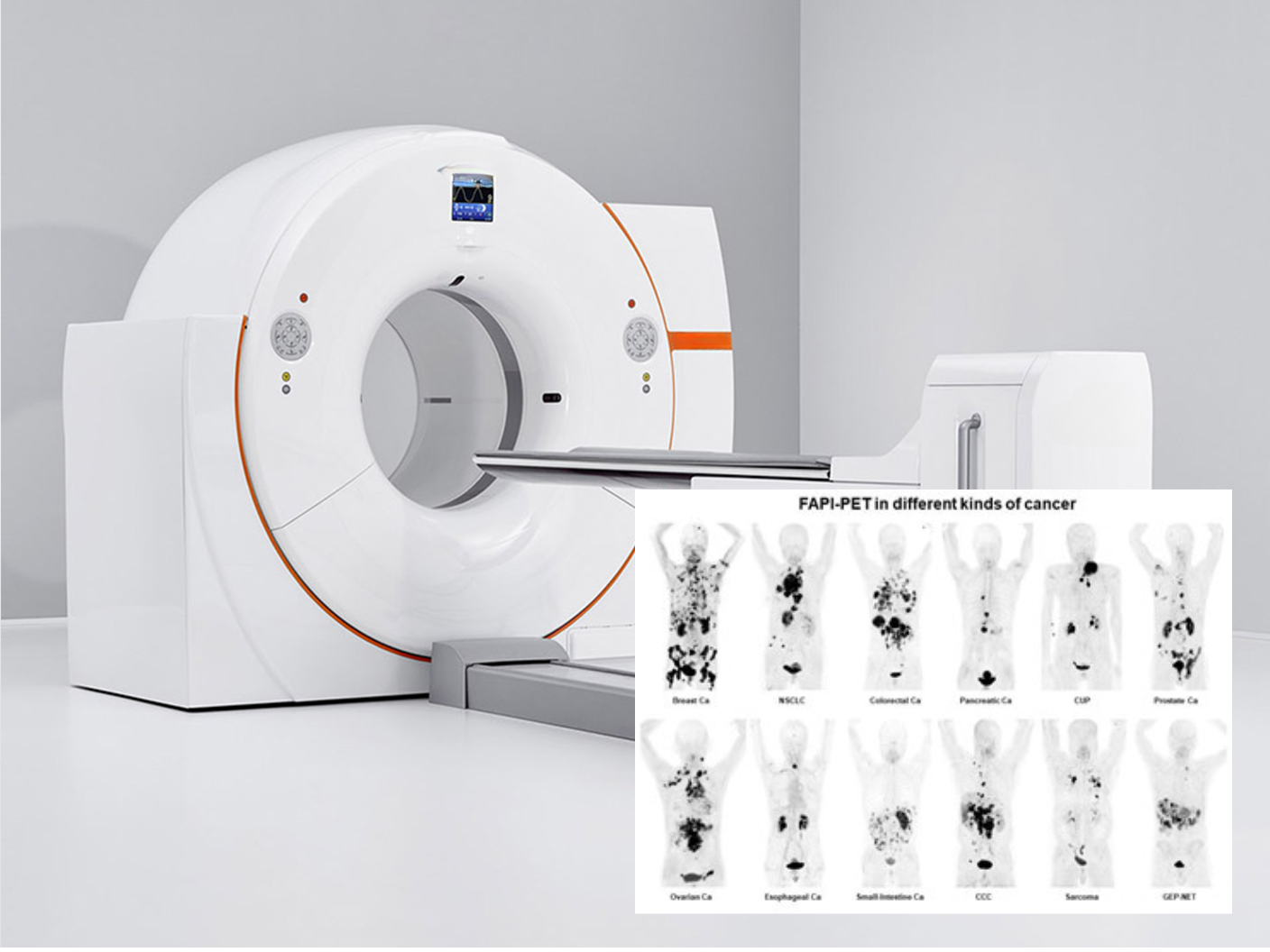 Introducing FAPI PET: A New Frontier in Cancer Imaging